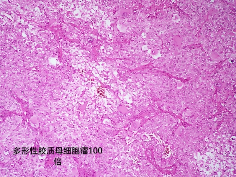 病理科工作札记（三十八）胶质母细胞瘤