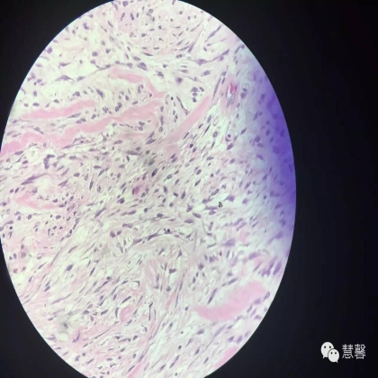 乳腺叶状肿瘤诊断（慧馨分享，孔祥田(Max)*Roswell*NM老师讲解）