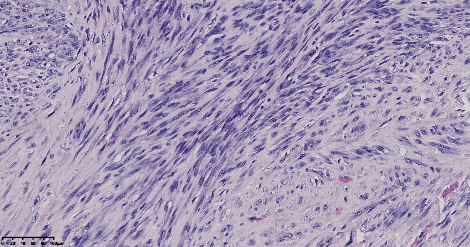 子宫多发性平滑肌瘤伴肉瘤