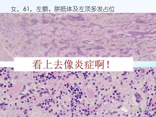 中枢神经系统弥漫大B细胞淋巴瘤