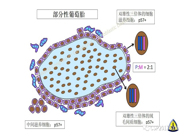 p57免疫组化染色及基因分型 在葡萄胎精确诊断中的应用