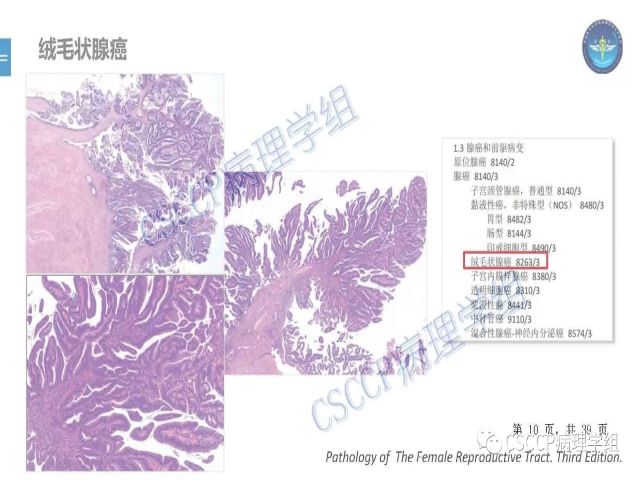 黄文亭 张询：宫颈腺癌分类介绍