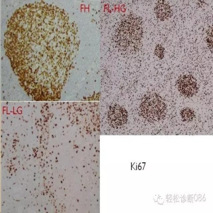 滤泡性淋巴瘤
