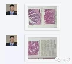 结、直肠管绒毛状腺瘤-高级别病变诊断等相关问题2（悄悄分享、孔祥田(Max)*Roswell*老师讲解）