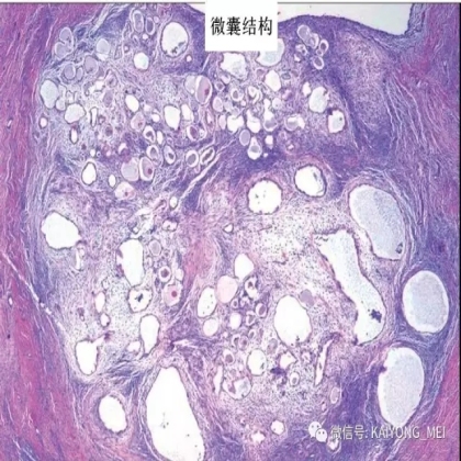 卵巢癌的病理诊断新进展（三）