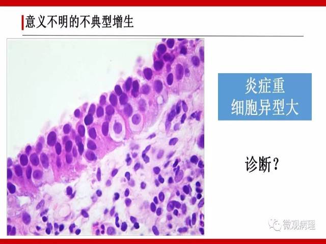 泌尿课程/非浸润性尿路上皮病变诊断的一些困惑