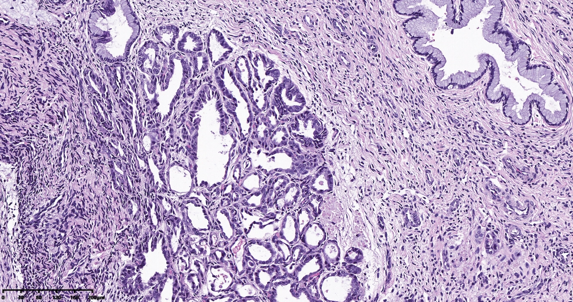 子宫透明细胞癌？