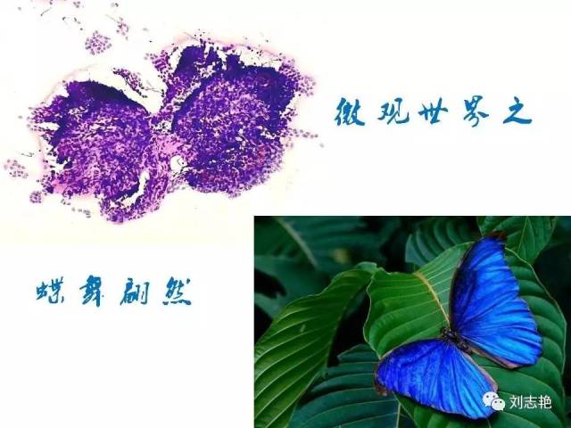 另类甲状腺FNA细胞学