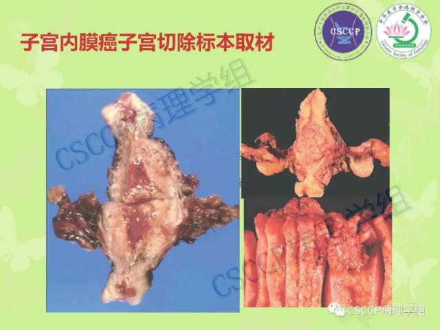 宫颈与子宫病变病理标本取材