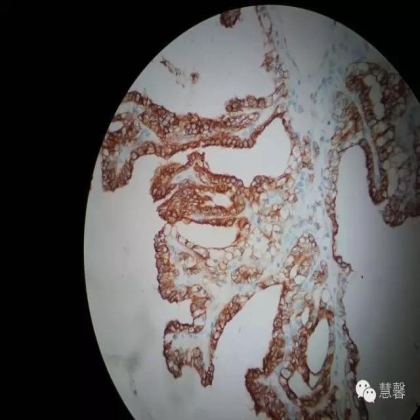 透明细胞乳头状肾细胞癌？TFE3 Traslocation Carcinoma？（赵洋分享，孔祥田(Max)*NM老师讲解）