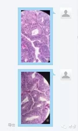结、直肠管绒毛状腺瘤-高级别病变取材、诊断及报告相关问题（悄悄分享、掌心及孔祥田(Max)*Roswell*NM老师讲解）
