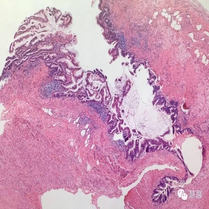 低级别黏液性肿瘤转移到卵巢伴腹腔假黏液瘤形成【小车】分享；【刘从容】老师讲解