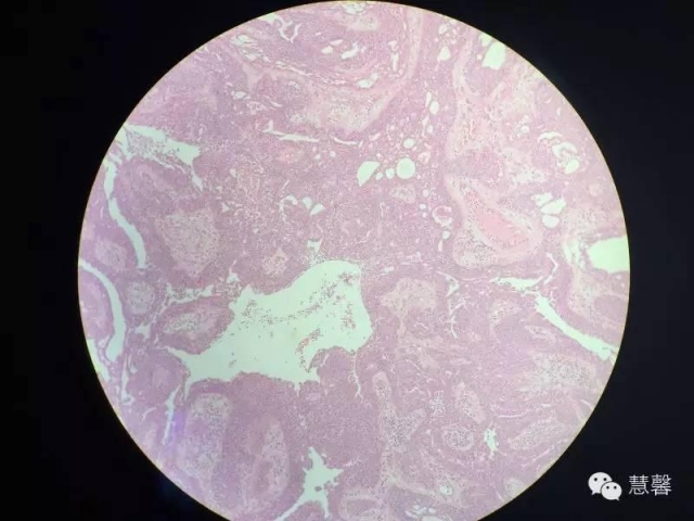 乳头状汗管囊腺瘤诊断及取材相关问题（迟悟分享，孔祥田及于励民老师讲解）