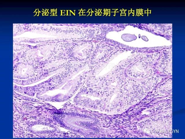 子宫内膜癌：诊断与进展