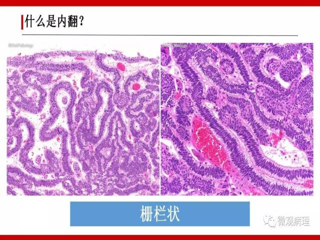 泌尿课程/尿路上皮病变的基本生长方式
