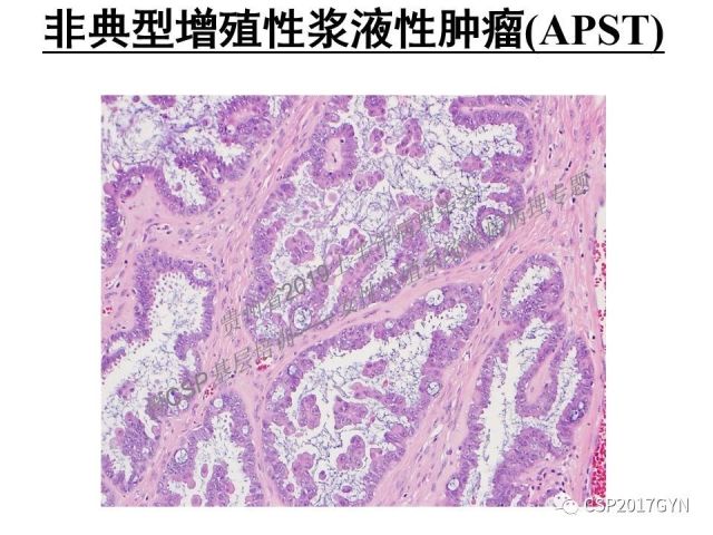 中华病理学会基层培训遵义站讲座（一）——卵巢和输卵管浆液性肿瘤的诊断和鉴别诊断