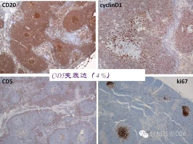 关于套细胞淋巴瘤的总结课件