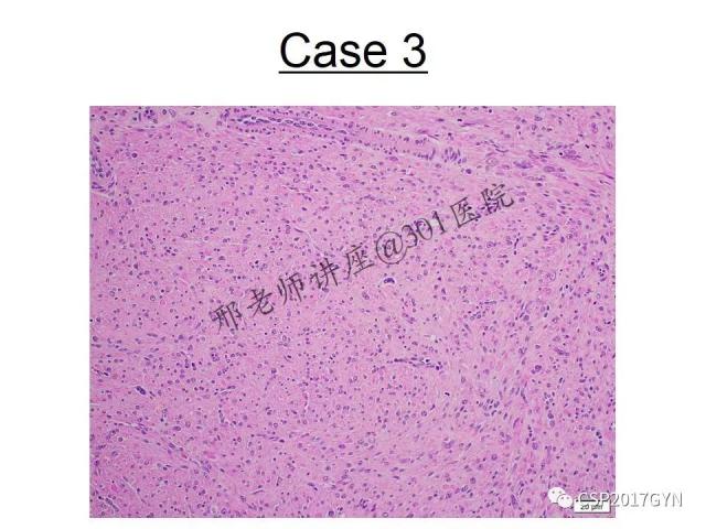 典型妇科病理病例的探究与分析