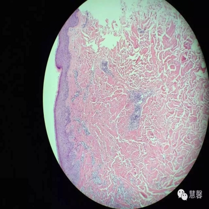 Acquired perforating dermatosis（孔祥田(Max)*Roswell*NM]分享及讲解）