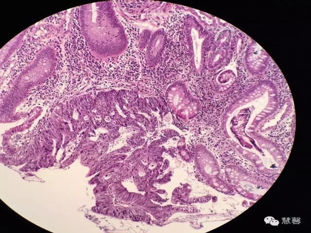 结、直肠管绒毛状腺瘤-高级别病变诊断等相关问题2（悄悄分享、孔祥田(Max)*Roswell*老师讲解）