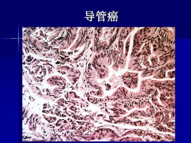 前列腺病理诊断线索（上）——黄教悌