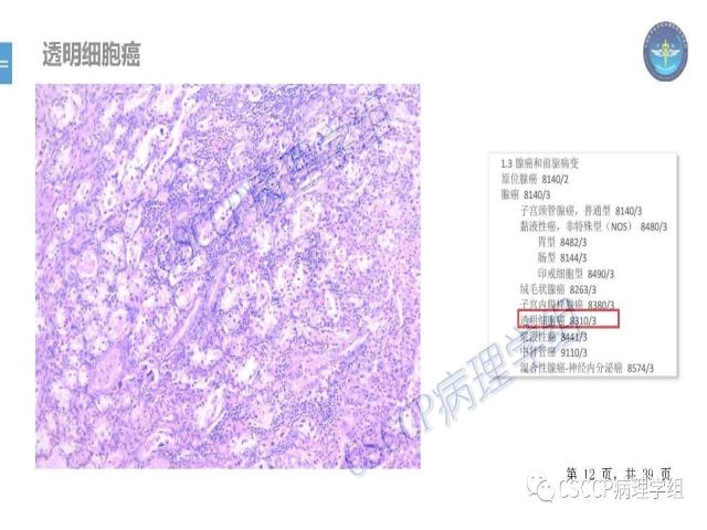 黄文亭 张询：宫颈腺癌分类介绍