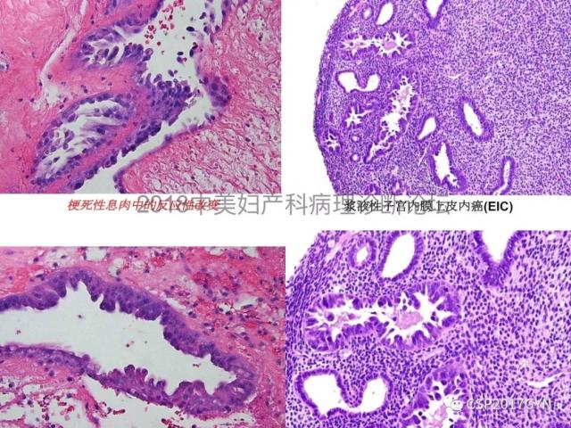 子宫内膜假肿瘤性病变及类似癌样病变