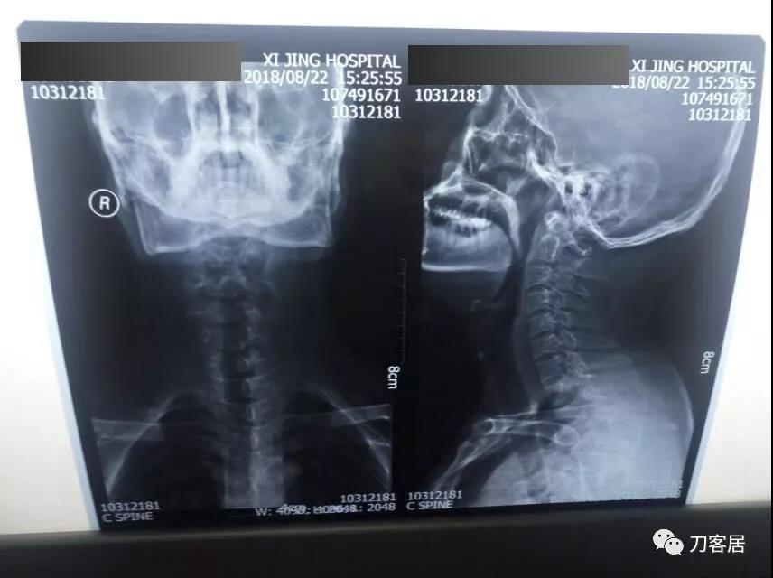 医生及患者通用:如何用手机翻拍X线片,磁共振片子,CT片子进行网络求医、病例讨论及保留资料 医生及患者通用:如何用手机翻拍X线片,磁共振片子,CT片子进行网络求医、病例讨论及保留资料