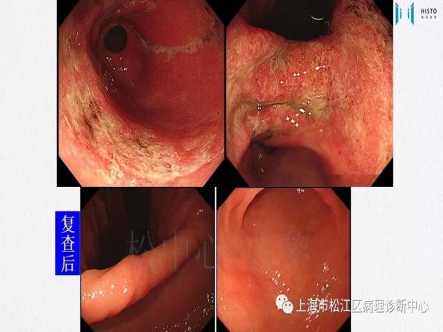 上消化道早癌病理诊断中的困惑及基本对策回顾
