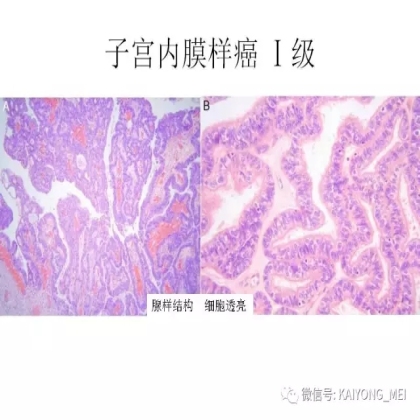 卵巢癌的病理诊断新进展（二）