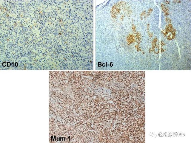 HIV/AIDS相关性LPDHIV感染相关淋巴瘤病例分析