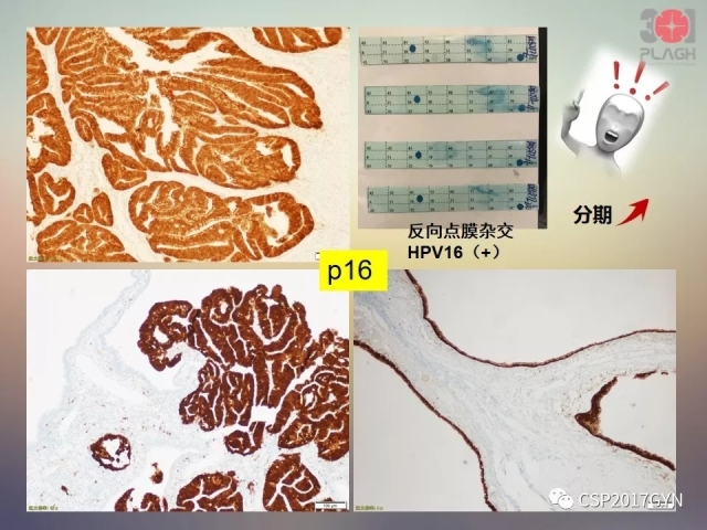 宫颈腺癌的临床病理研究进展