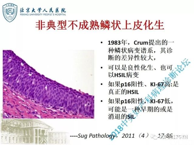 宫颈鳞状上皮内病变病理诊断中问题