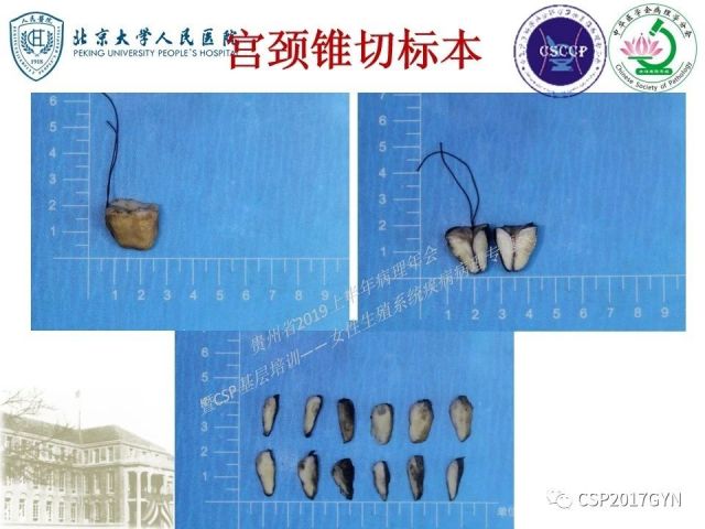中华病理学会基层培训遵义站讲座（三）——宫颈鳞状上皮病变的病理诊断与鉴别诊断