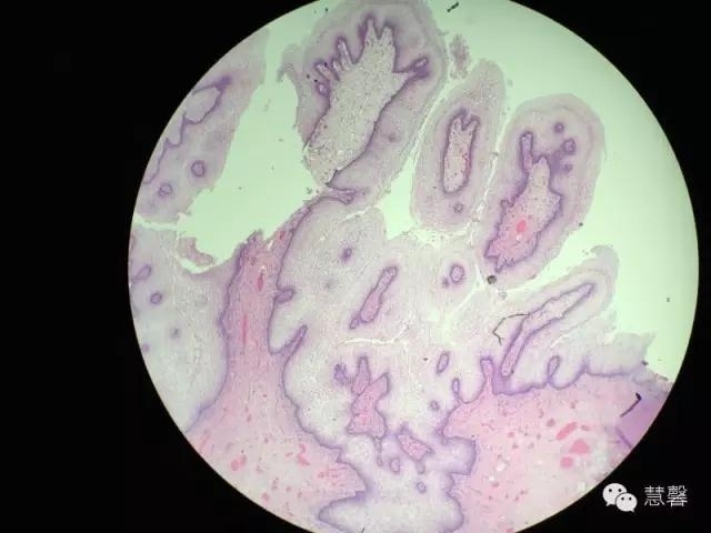 阴道鳞状上皮乳头状瘤？尖锐湿疣？（孔祥田老师病例分享，粉蓝医疗科技（杭州）有限公司女性生殖2群讨论，孔祥田(Max)*Roswell*老师讲解）