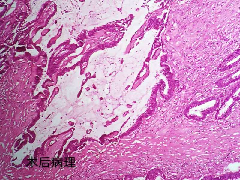 病理科工作札记（三十五）二次活检