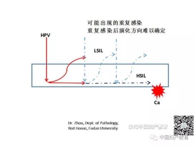 独家专访国内妇产科病理大咖周先荣教授：子宫颈上皮内病变及相关临床情况的若干病理学问题（一）