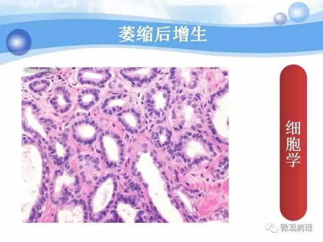 泌尿课程/局灶性前列腺萎缩