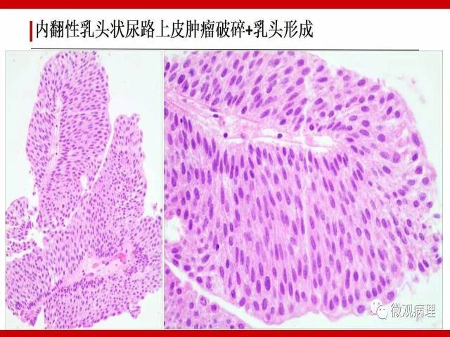 膀胱尿路上皮肿瘤诊断的一些困惑