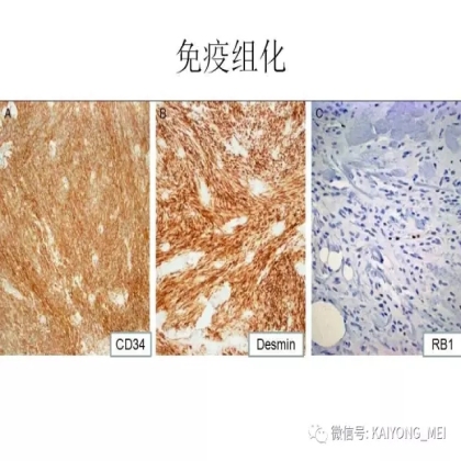 女性生殖道软组织肿瘤病理诊断及进展（二）