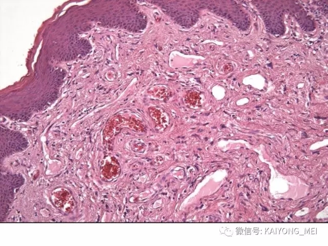 女性生殖道软组织肿瘤病理诊断及进展（一）