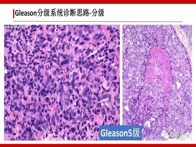 前列腺癌Gleason分级系统的前世今生
