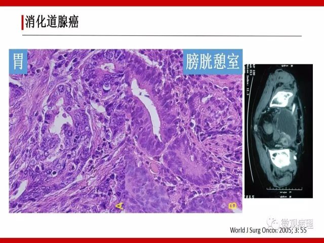 泌尿课程/尿路腺样病变的诊断要点