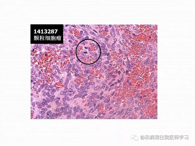 病理学基础知识 : 核分裂像的识别