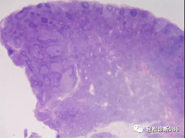 免疫缺陷相关性淋巴组织增殖性疾病（2）