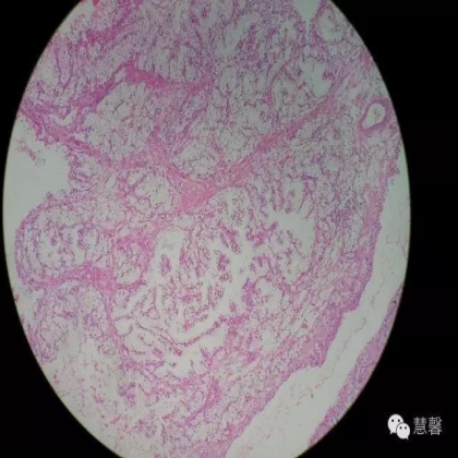 透明细胞乳头状肾细胞癌？TFE3 Traslocation Carcinoma？（赵洋分享，孔祥田(Max)*NM老师讲解）