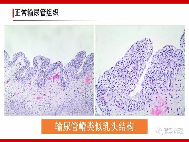 泌尿课程/非浸润性尿路上皮病变诊断的一些困惑