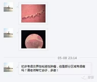 交界性黏液性囊腺瘤？癌？（魏娉分享，刘从容老师讲解）