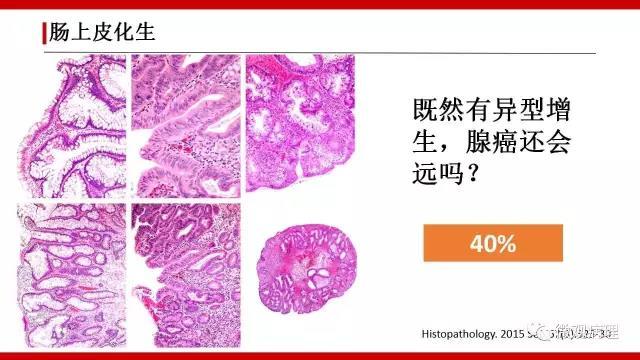 泌尿课程/尿路腺样病变的诊断要点