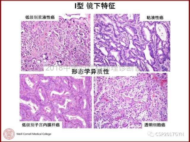 非粘液性卵巢肿瘤的诊断挑战